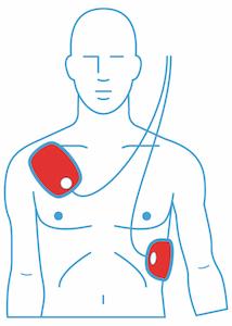 Anwendung Laien-Defi
