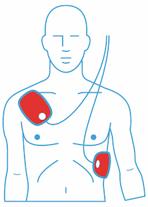 Bedienung Laien-Defibrillator